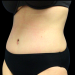 Tummy Tuck Before & After Patient #4076