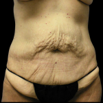 Tummy Tuck Before & After Patient #4077