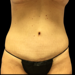 Tummy Tuck Before & After Patient #4077