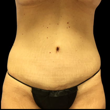 Tummy Tuck Before & After Patient #4077
