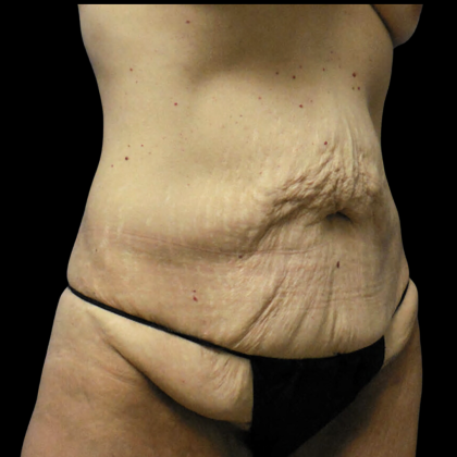 Tummy Tuck Before & After Patient #4077