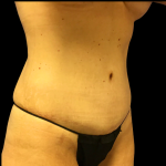 Tummy Tuck Before & After Patient #4077