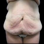 Tummy Tuck Before & After Patient #4078