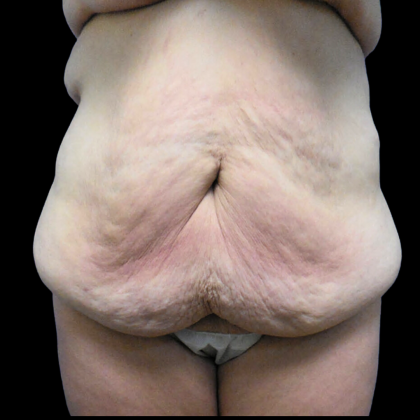 Tummy Tuck Before & After Patient #4078