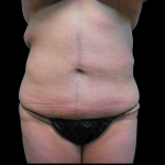 Tummy Tuck Before & After Patient #4078