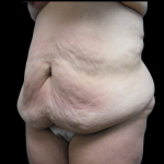 Tummy Tuck Before & After Patient #4078