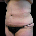 Tummy Tuck Before & After Patient #4078