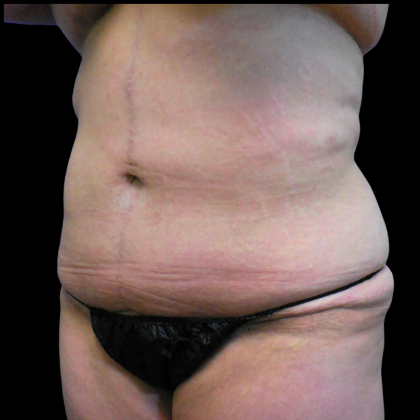 Tummy Tuck Before & After Patient #4078