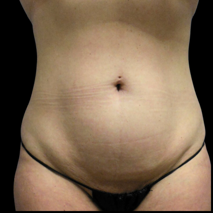 Tummy Tuck Before & After Patient #4079