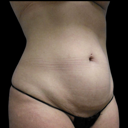 Tummy Tuck Before & After Patient #4079