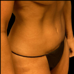 Tummy Tuck Before & After Patient #4079