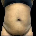 Tummy Tuck Before & After Patient #4080