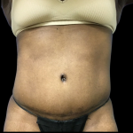 Tummy Tuck Before & After Patient #4080
