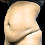 Tummy Tuck Before & After Patient #4080