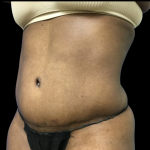 Tummy Tuck Before & After Patient #4080