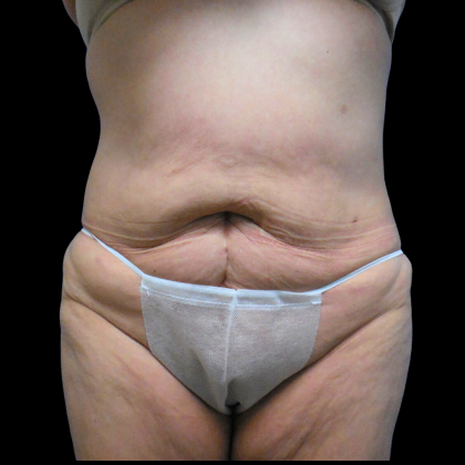 Tummy Tuck Before & After Patient #4639