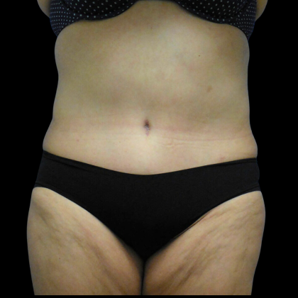 Tummy Tuck Before & After Patient #4639