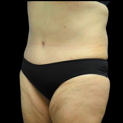 Tummy Tuck Before & After Patient #4639