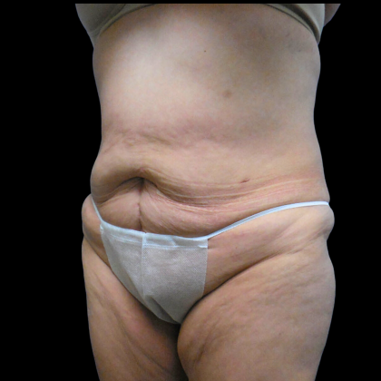 Tummy Tuck Before & After Patient #4639
