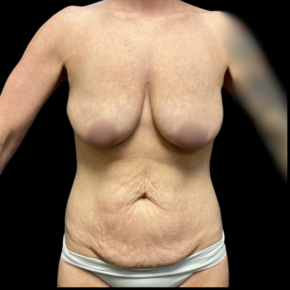 Breast Augmentation Before & After Patient #4035
