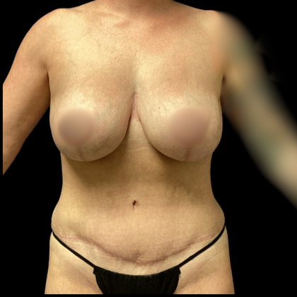 Breast Augmentation Before & After Patient #4035