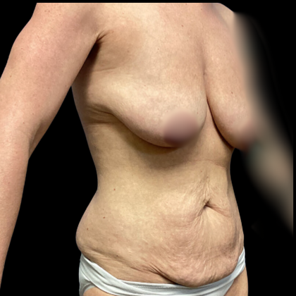 Breast Augmentation Before & After Patient #4035