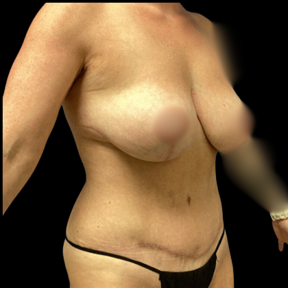 Breast Augmentation Before & After Patient #4035