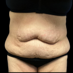 Tummy Tuck Before & After Patient #4082