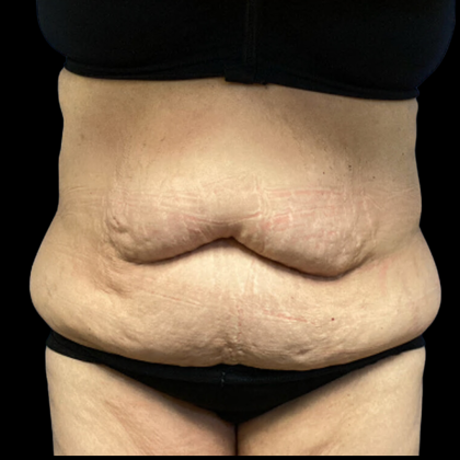 Tummy Tuck Before & After Patient #4082
