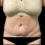 Tummy Tuck Before & After Patient #4082