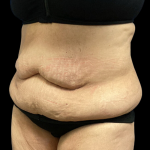 Tummy Tuck Before & After Patient #4082