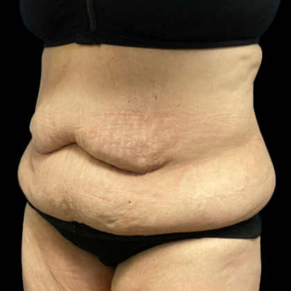Tummy Tuck Before & After Patient #4082