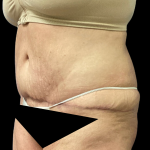 Tummy Tuck Before & After Patient #4082
