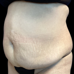 Tummy Tuck Before & After Patient #4562
