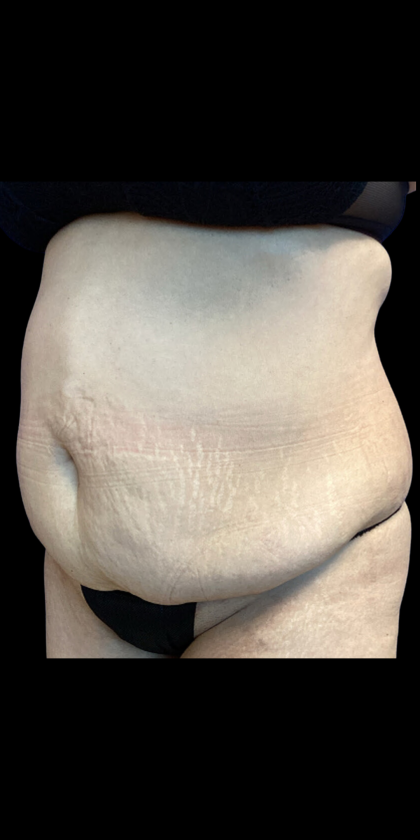 Tummy Tuck Before & After Patient #4562