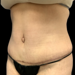 Tummy Tuck Before & After Patient #4562
