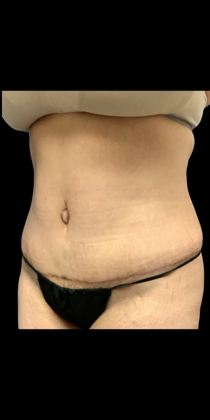 Tummy Tuck Before & After Patient #4562