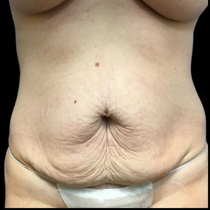 Tummy Tuck Before & After Patient #4455