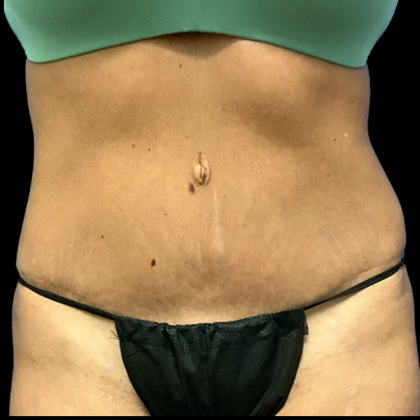 Tummy Tuck Before & After Patient #4455