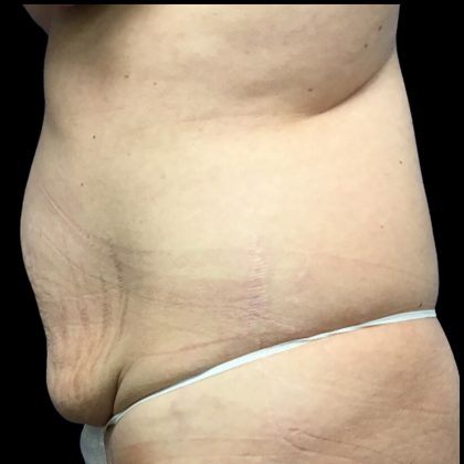 Tummy Tuck Before & After Patient #4455