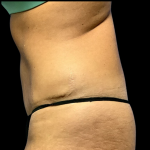 Tummy Tuck Before & After Patient #4455