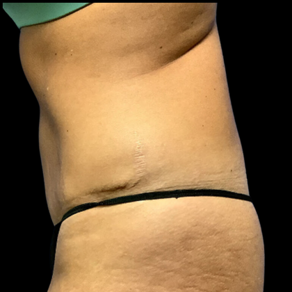 Tummy Tuck Before & After Patient #4455