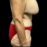 Mommy Makeover Before & After Patient #4577