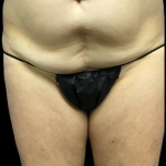 Tummy Tuck Before & After Patient #4622