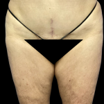 Tummy Tuck Before & After Patient #4622