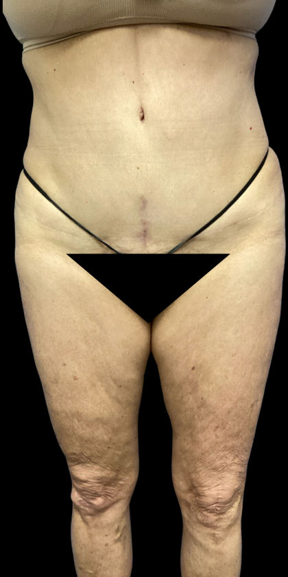 Tummy Tuck Before & After Patient #4622