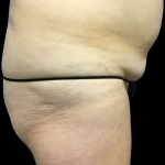 Tummy Tuck Before & After Patient #4622