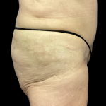 Tummy Tuck Before & After Patient #4622