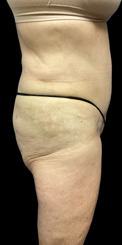 Tummy Tuck Before & After Patient #4622