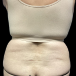 Tummy Tuck Before & After Patient #4622